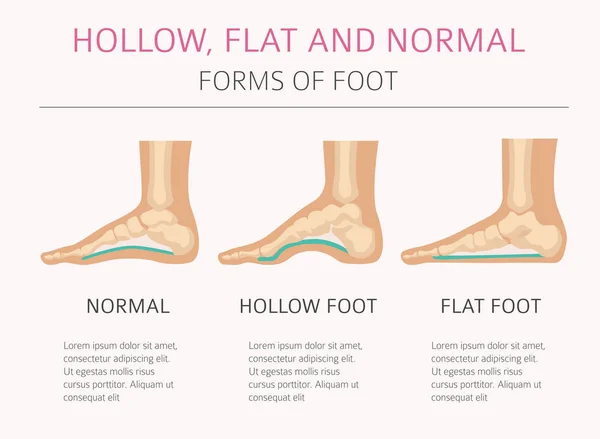 Fußdeformationen, medizinische Krankheitsinfografik. hohl, fl — Stockvektor