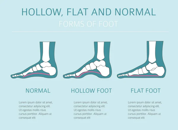 Типы деформации ног, инфографика заболеваний. Пустота, fl — стоковый вектор