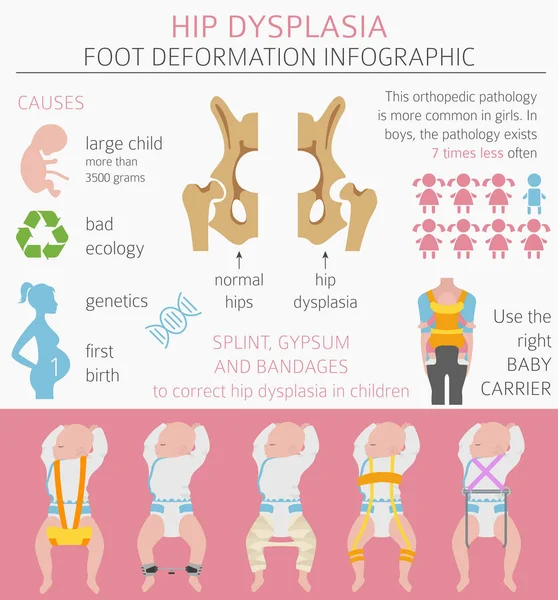 Deformasyon türleri, tıbbi desease Infographic ayak. Kalça dyspla — Stok Vektör