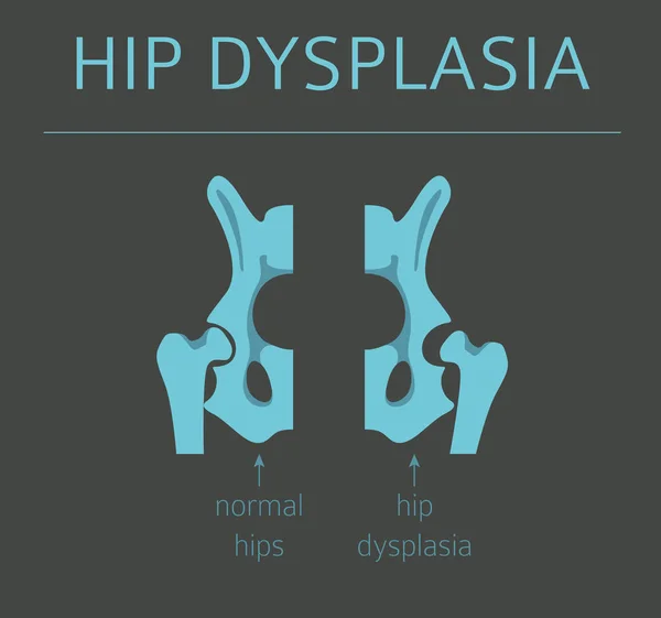 Voet vervorming typen, medische toegegeven infographic. Hip dyspla — Stockvector