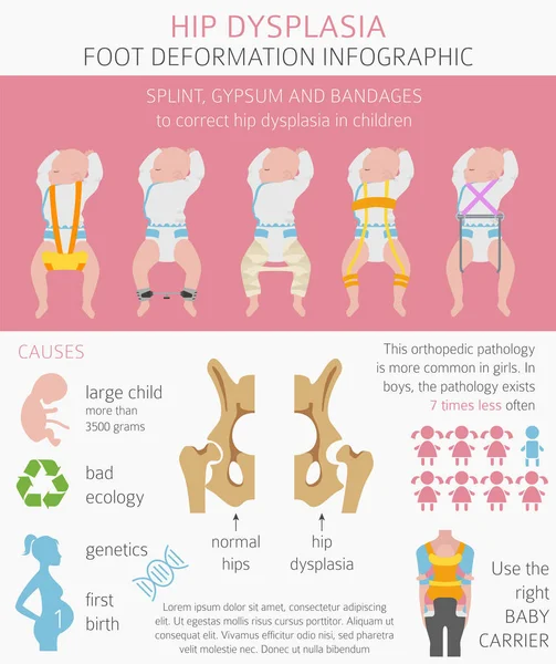 Tipos de deformación del pie, infografía de enfermedades médicas. Disnea de cadera — Vector de stock