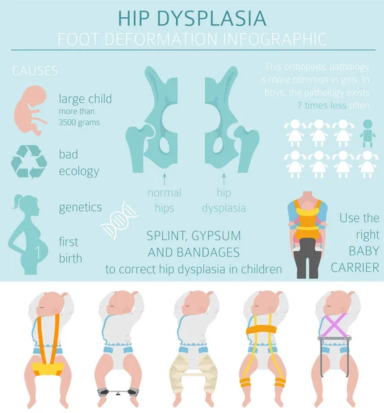Τύποι ποδιών παραμόρφωση, infographic ιατρικό νόσημα. Χιπ dyspla — Διανυσματικό Αρχείο