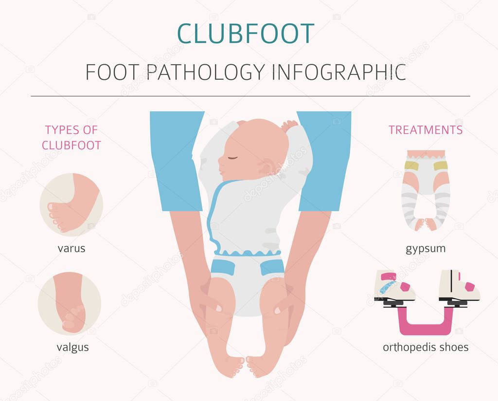 Foot deformation, medical desease infographic. Clubfoot defect