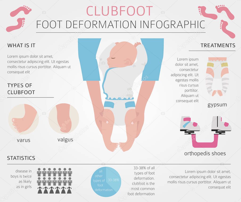 Foot deformation, medical desease infographic. Clubfoot defect