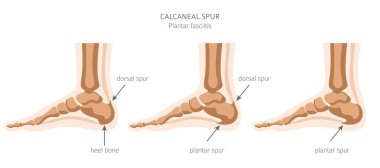 Kalkaneal çıkıntı. Plantar fasiiti ayarlandı. Tıbbi Hastalık İnfografı