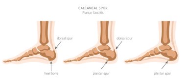 Calcaneal spur. Plantar fasciitis set. Medical desease infograph clipart