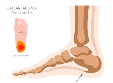 Kalkaneal çıkıntı. Plantar fasiiti ayarlandı. Tıbbi Hastalık İnfografı