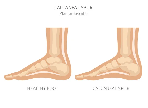 Calcaneal memacu. Plantar fasciitis sudah siap. Infograf desease medis - Stok Vektor