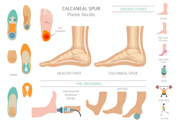 Calcaneale sporen. Plantaire fasciitis ingesteld. Medische ontsmettingsinfograaf — Stockvector