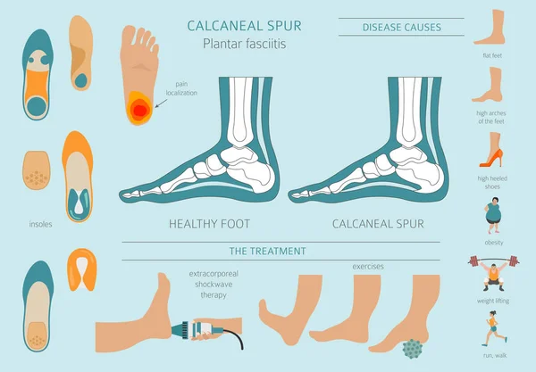 Uno sperone calcaneare. Fascite plantare impostata. Infografia di malattia medica — Vettoriale Stock