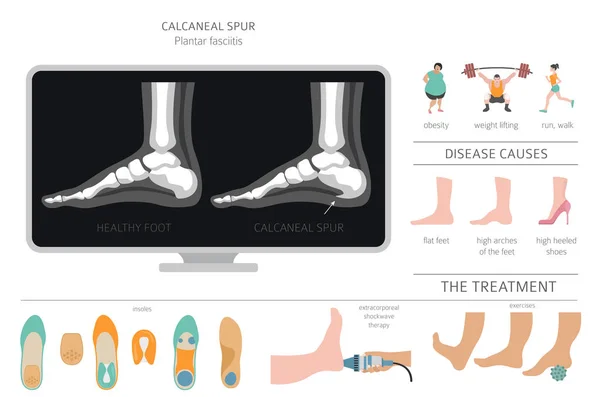 Uno sperone calcaneare. Fascite plantare impostata. Infografia di malattia medica — Vettoriale Stock