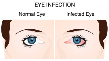 Eye Infection Conjunctivitis clipart