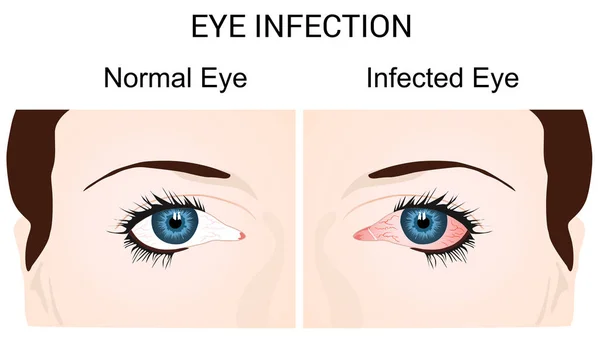 Zapalenie spojówek Infekcja oka — Wektor stockowy