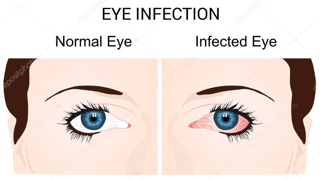 Eye Infection Conjunctivitis