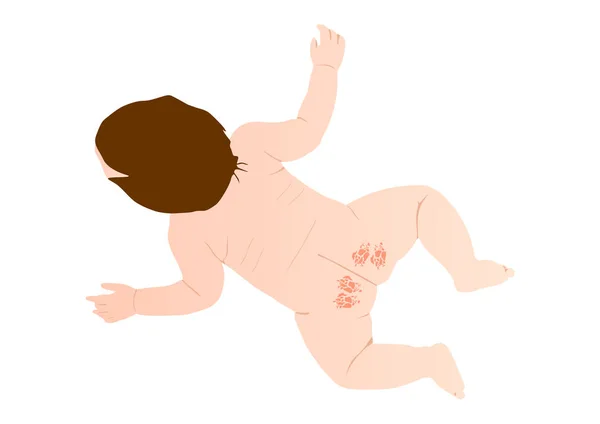 Éruption cutanée des couches pour bébé — Image vectorielle
