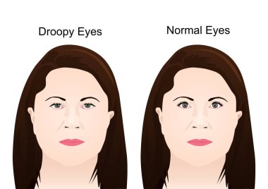 Droopy Eyelid's Surgery clipart