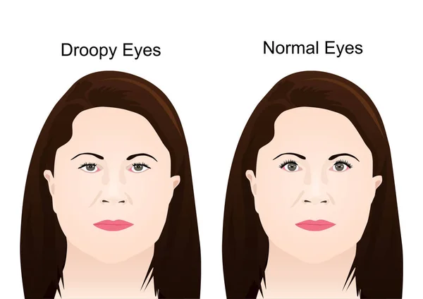 Cirurgia da pálpebra Droopy — Vetor de Stock