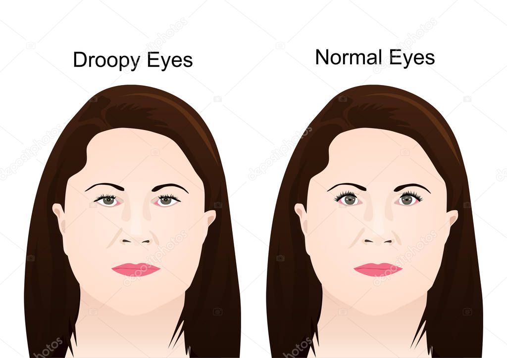 Droopy Eyelid's Surgery