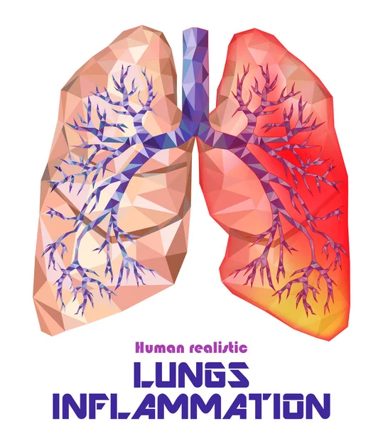 Pulmones humanos poco realistas y bronquios con inflamación del cáncer — Vector de stock