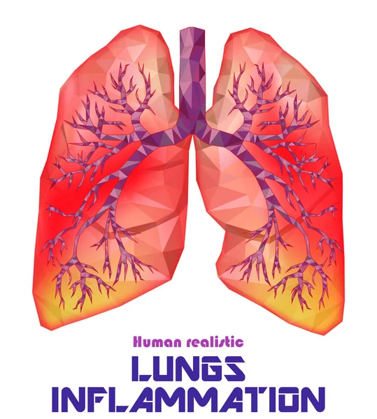 Pulmones humanos enfermos realistas y tráquea en poli baja. Pleuresía, una — Vector de stock