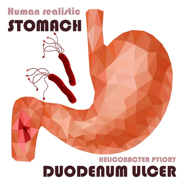 Реалистичный низкий поли человеческого желудка и воспаление двенадцатиперстной кишки — стоковый вектор
