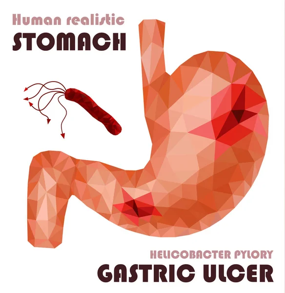 Realista bajo poli estómago humano y duodeno. Dolor de estómago, úlcera — Vector de stock