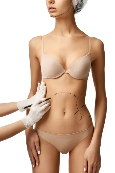 Corpo femminile con le frecce di disegno sulla pancia per la liposuzione chirurgia plastica — Foto Stock