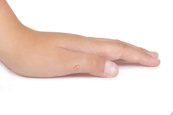 Female hand with warts isolated on white background — Stock Photo, Image