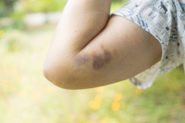 Bruising kadar yaşlı kadının kolundaki kapatın. Kadın şiddet kavramı, kolunda çürükler.
