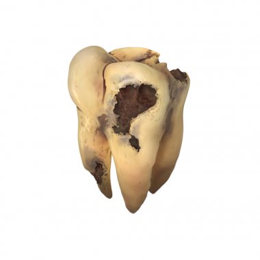 Beyaz izole diş çürüğü.