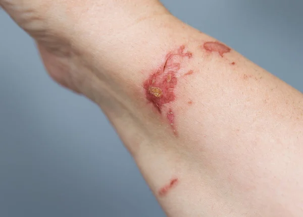 Chemical burn on woman hand. — Stock Photo, Image