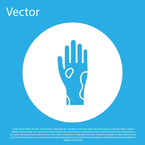 Mano blu con psoriasi o icona di eczema isolato su sfondo blu. Concetto di risposta della pelle umana ad allergeni o problemi cronici del corpo. Pulsante cerchio bianco. Illustrazione vettoriale — Vettoriale Stock