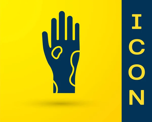 Mão azul com psoríase ou ícone de eczema isolado no fundo amarelo. Conceito de resposta da pele humana ao alérgeno ou problema crônico do corpo. Ilustração vetorial — Vetor de Stock