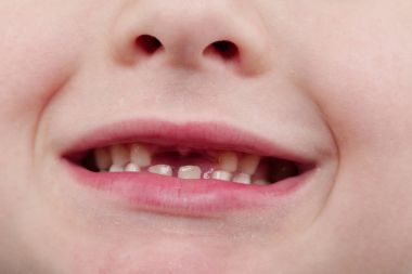Değişen dişlerini gösteren mutlu yakışıklı çocuk