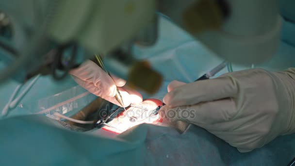 Oftalmologie chirurgen binnen de interventie — Stockvideo