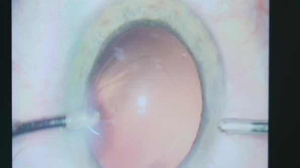 眼科学手术工具内的干预 — 图库视频影像