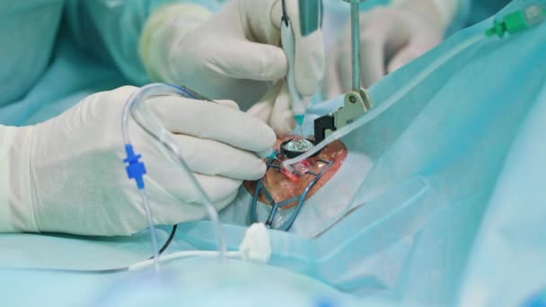 Oftalmologie chirurgen binnen de interventie — Stockvideo