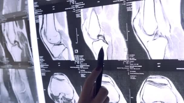 Врач смотрит через рентген суставов. Снимок МРТ суставов — стоковое видео