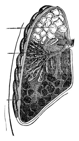 Poumon Infecté Par Une Pneumonie Croûtée Vésiculeuse Domaine Consolidation Montre — Image vectorielle
