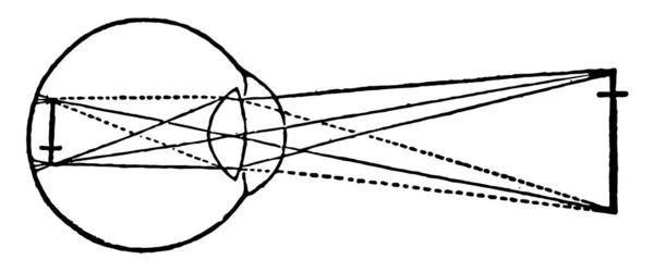 Resimde Miyop Vizyon Vintage Çizgi Çizme Veya Oyma Illüstrasyon Temsil — Stok Vektör