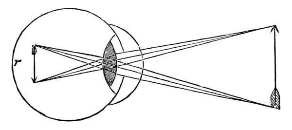 Diese Illustration Stellt Eine Konvexe Hornhaut Auf Dem Auge Dar — Stockvektor