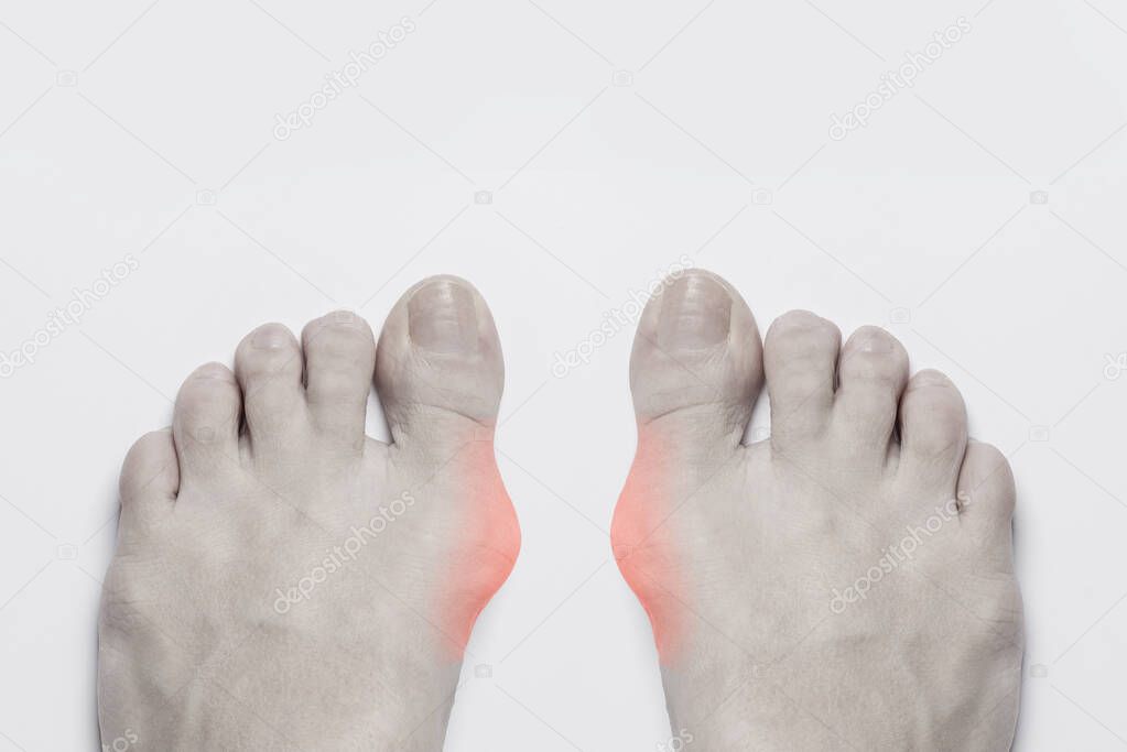 Bunion before surgical removal. Bunion at sides of both woman female feet, a common problem form wearing high heel. Bone and skin on the sides of joint of the big toe make abnormal foot shape