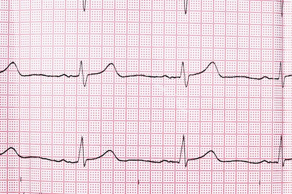 Sluiten van een elektrocardiogram in papieren vorm — Stockfoto