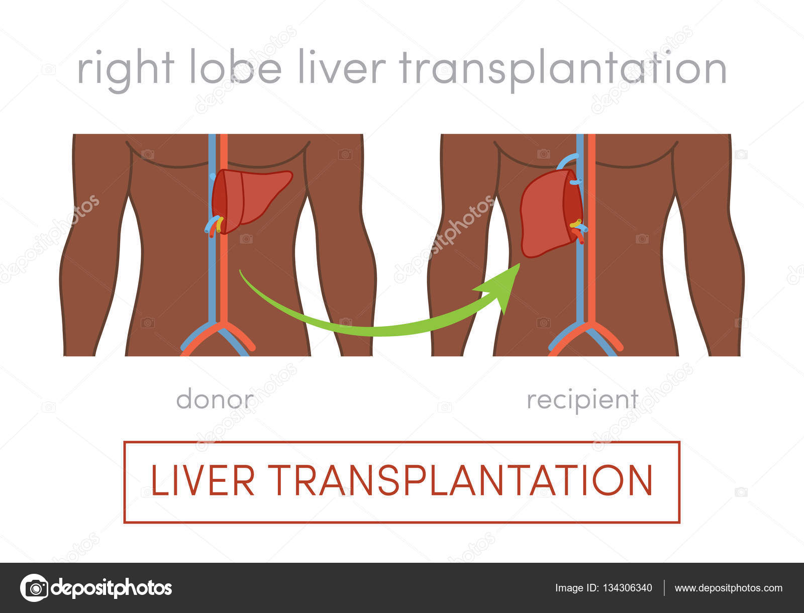 Karaciğer transplantasyonu Karaciğer transplantasyonu