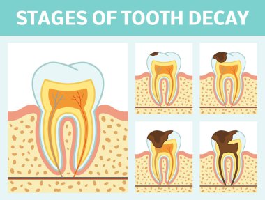 Tooth decay stages