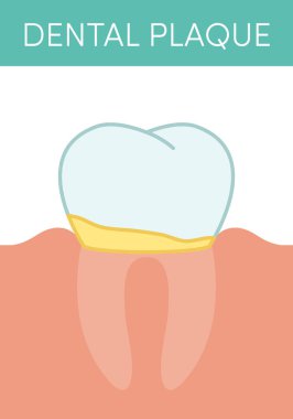 Dental plak kavramı