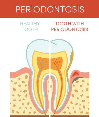 Tooth diseases: periodontosis. clipart