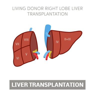 Liver transplantation concept clipart