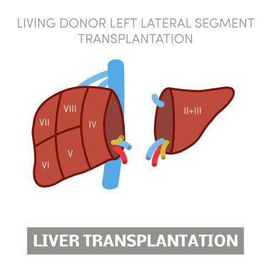 Liver transplantation concept clipart
