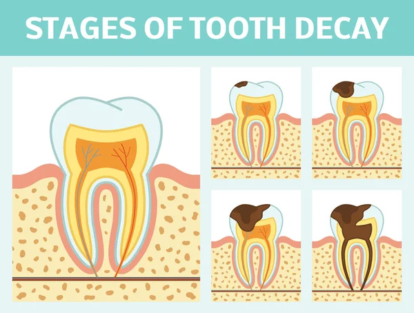 Etapas de caries dental — Archivo Imágenes Vectoriales